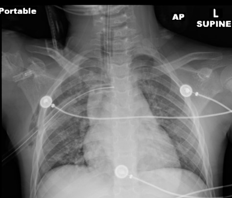 chest drain